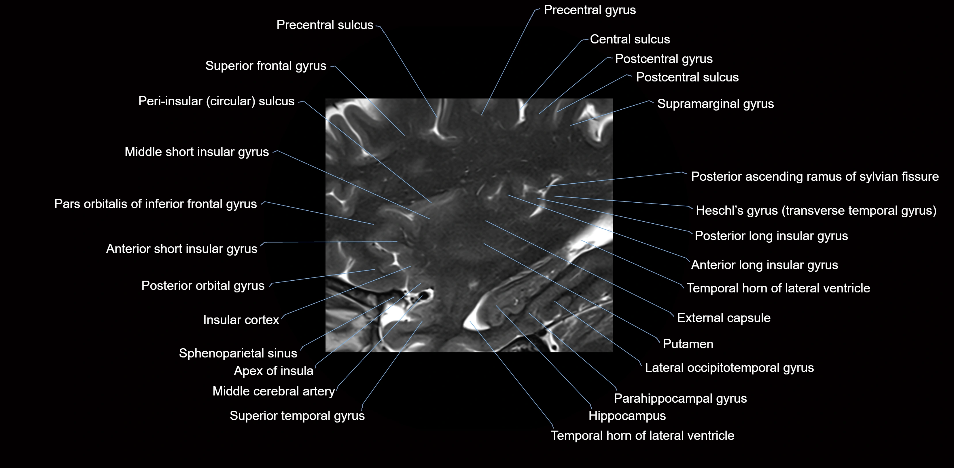 Insula cross section anatomy MRI sagittal 3t labelled image-img-00008.webp